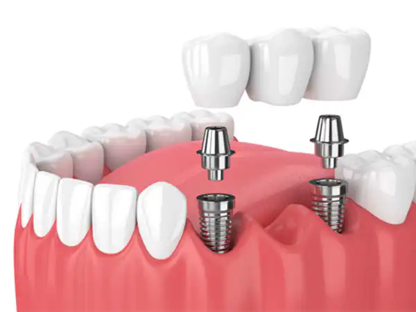 Why go to a Dentist in Puerto Vallarta?