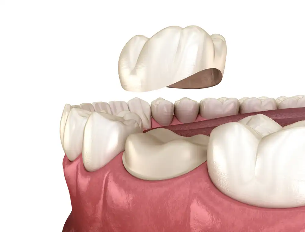 Why go to a Dentist in Puerto Vallarta?