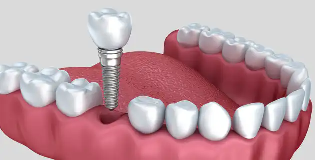Why go to a Dentist in Puerto Vallarta?