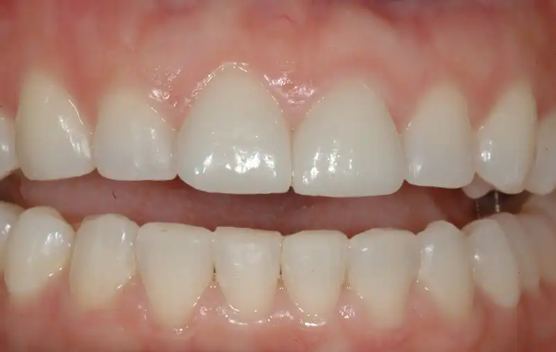 Why go to a Dentist in Puerto Vallarta?