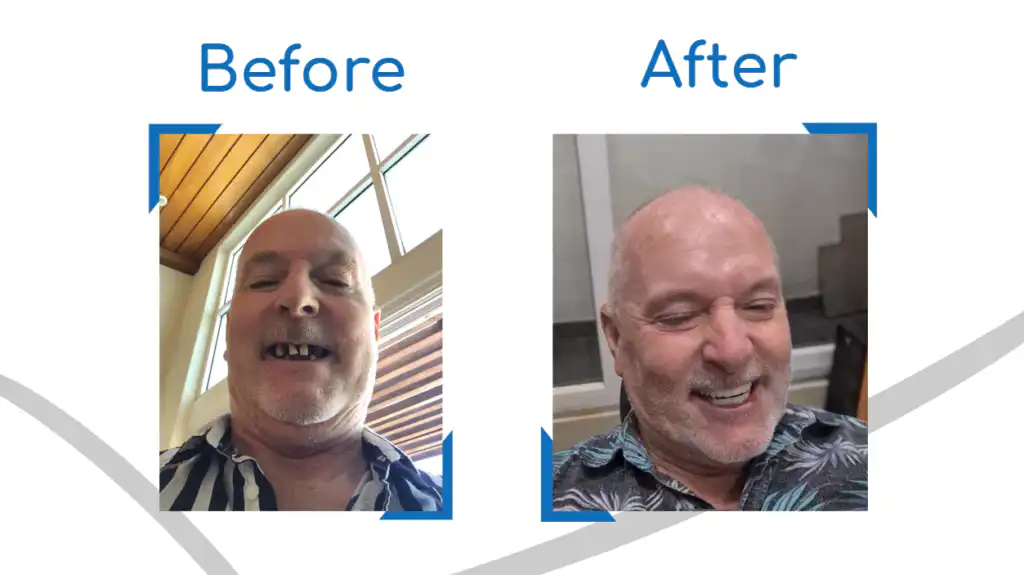 Why go to a Dentist in Puerto Vallarta?