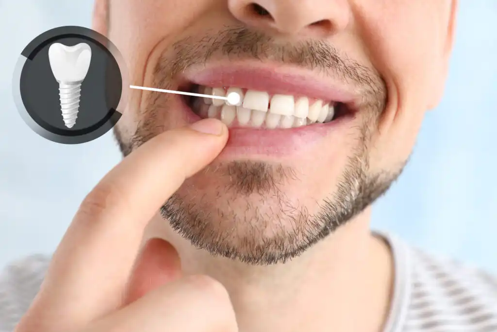 Need Dental Implants? Zirconia Special Offer $