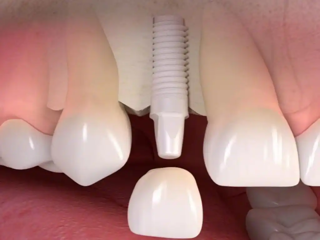 Need Dental Implants? Zirconia Special Offer $