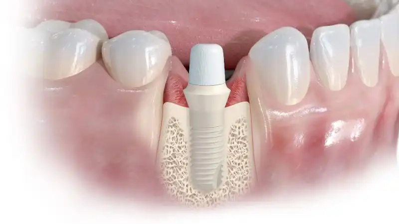 Need Dental Implants? Zirconia Special Offer $